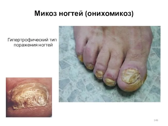 Микоз ногтей (онихомикоз) Гипертрофический тип поражения ногтей