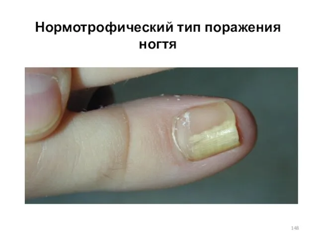 Нормотрофический тип поражения ногтя
