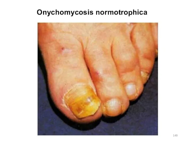 Onychomycosis normotrophica