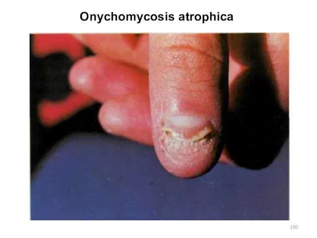 Onychomycosis atrophica