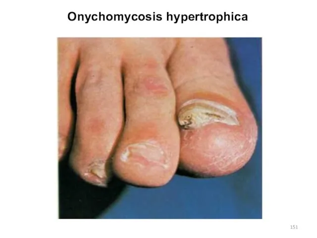 Onychomycosis hypertrophica