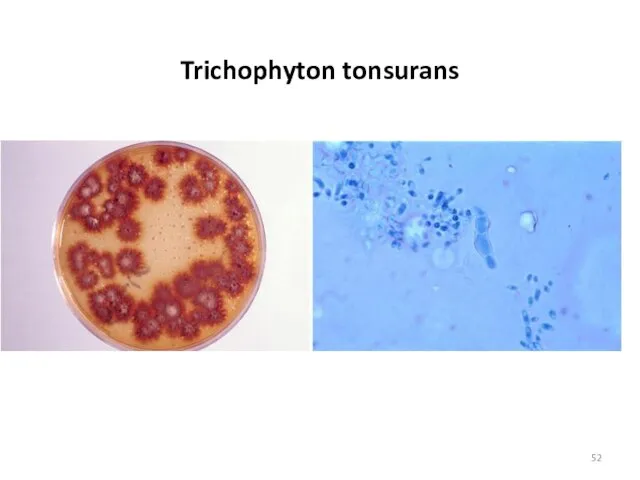 Trichophyton tonsurans