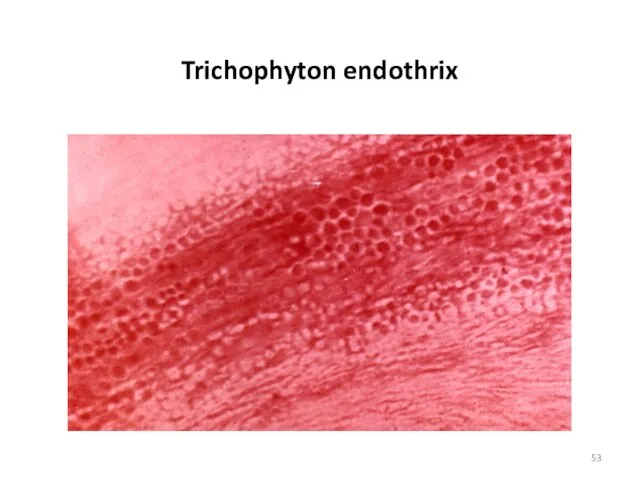 Trichophyton endothrix