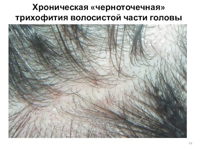 Хроническая «черноточечная» трихофития волосистой части головы