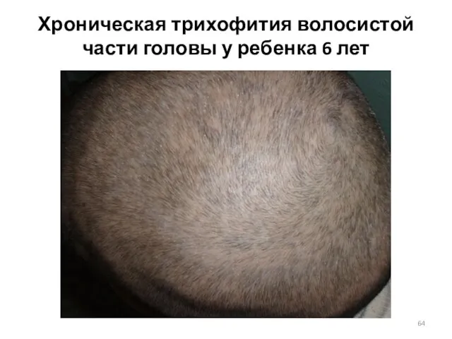 Хроническая трихофития волосистой части головы у ребенка 6 лет