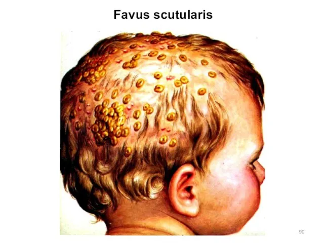 Favus scutularis