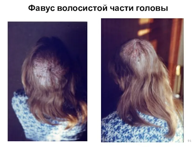Фавус волосистой части головы