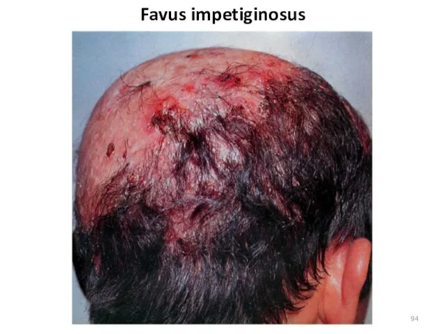 Favus impetiginosus