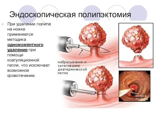 Эндоскопическая полипэктомия При удалении полипа на ножке применяется методика одномоментного удаления