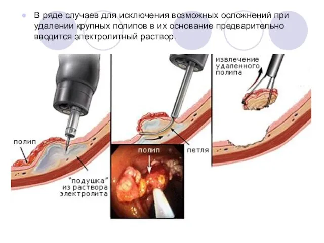 В ряде случаев для исключения возможных осложнений при удалении крупных полипов