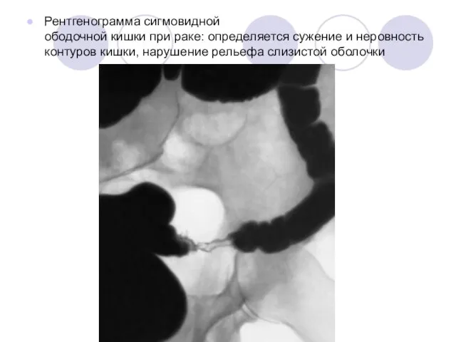 Рентгенограмма сигмовидной ободочной кишки при раке: определяется сужение и неровность контуров кишки, нарушение рельефа слизистой оболочки