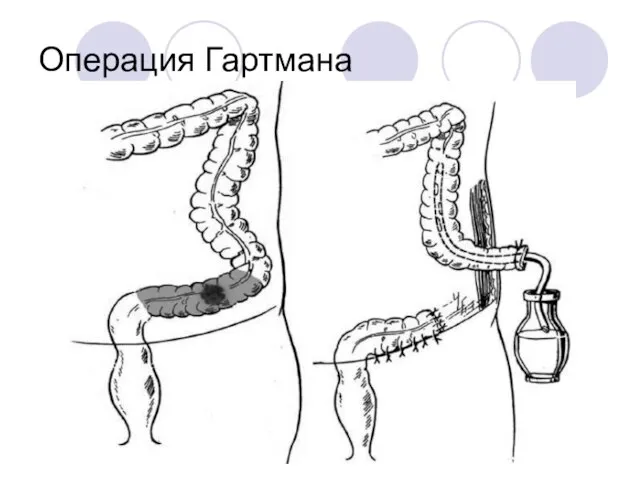 Операция Гартмана