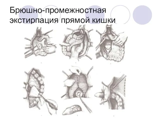 Брюшно-промежностная экстирпация прямой кишки