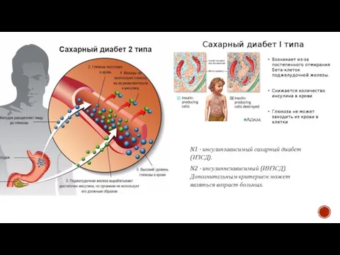 N1 - инсулинзависимый сахарный диабет (ИЗСД). N2 - инсулиннезависимый (ИНЗСД). Дополнительным критерием может являться возраст больных.