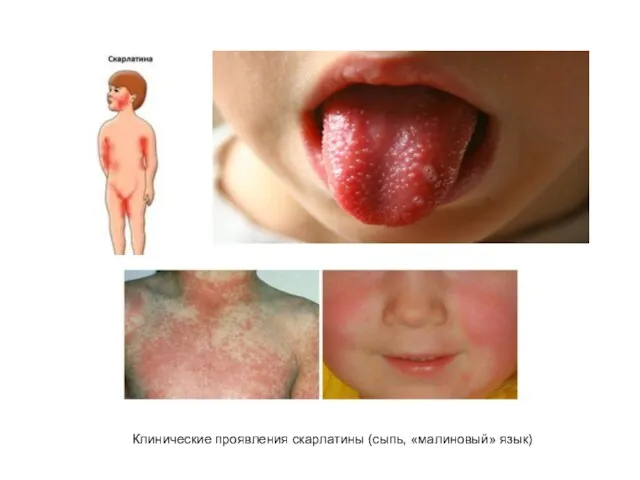 Клинические проявления скарлатины (сыпь, «малиновый» язык)