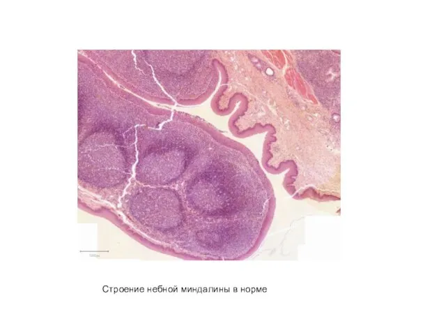 Строение небной миндалины в норме