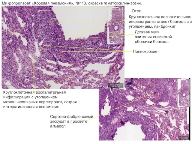 Микропрепарат «Коревая пневмония», №113, окраска гематоксилин-эозин. Круглоклеточная воспалительная инфильтрация стенок бронхов