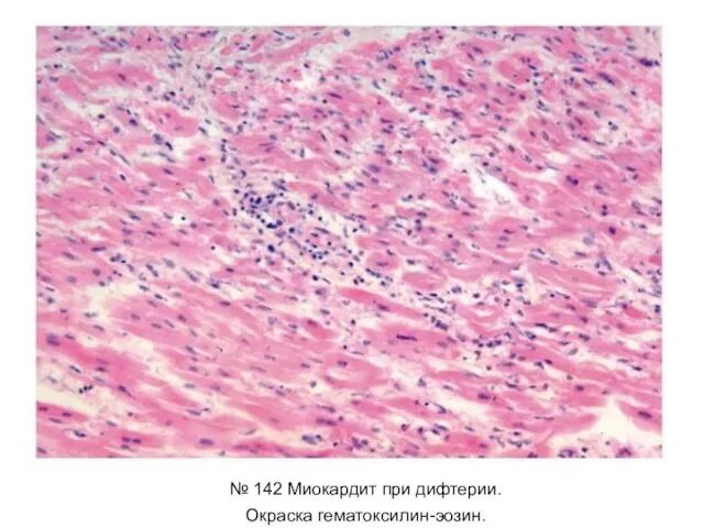 № 142 Миокардит при дифтерии. Окраска гематоксилин-эозин.