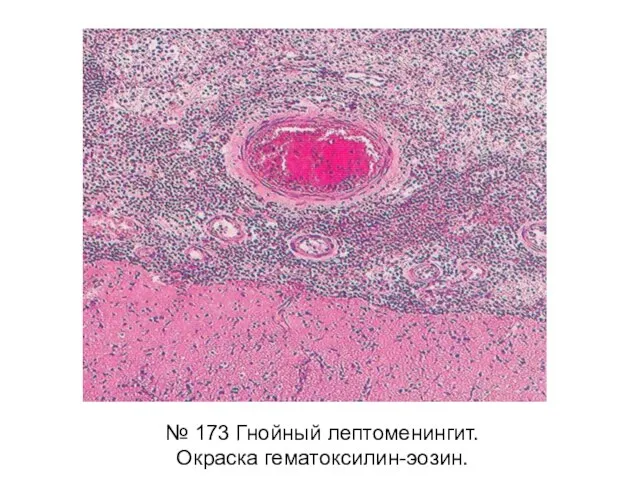 № 173 Гнойный лептоменингит. Окраска гематоксилин-эозин.