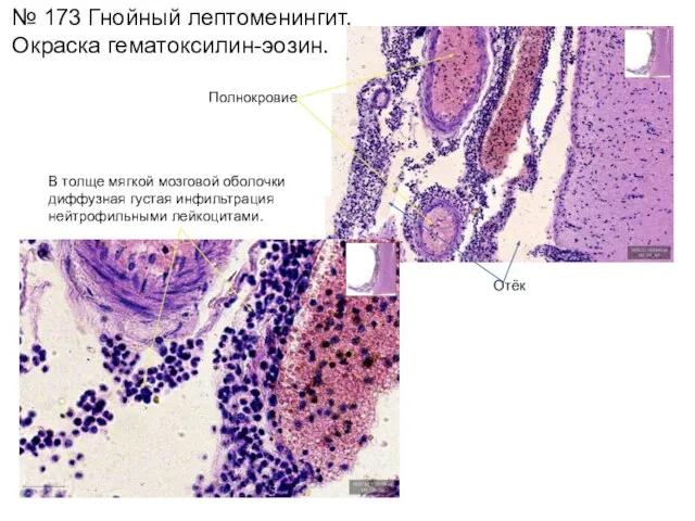 Полнокровие № 173 Гнойный лептоменингит. Окраска гематоксилин-эозин. В толще мягкой мозговой
