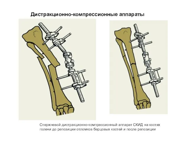 Дистракционно-компрессионные аппараты Стержневой дистракционно-компрессионный аппарат СКИД на костях голени до репозиции