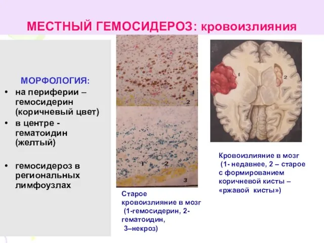 МЕСТНЫЙ ГЕМОСИДЕРОЗ: кровоизлияния МОРФОЛОГИЯ: на периферии – гемосидерин (коричневый цвет) в