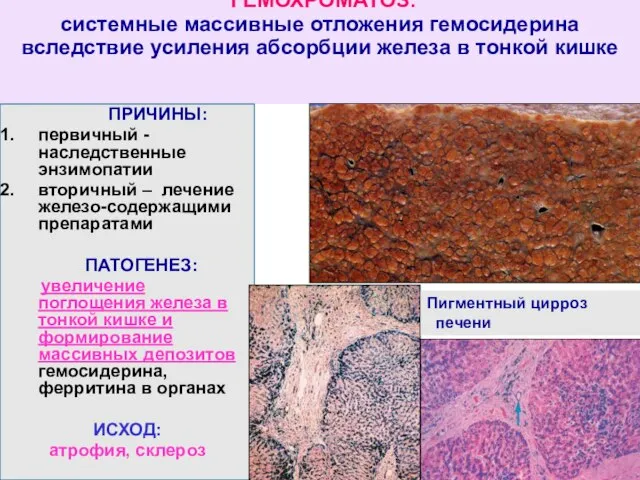 ГЕМОХРОМАТОЗ: системные массивные отложения гемосидерина вследствие усиления абсорбции железа в тонкой