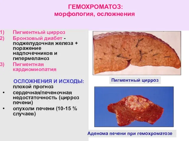 ГЕМОХРОМАТОЗ: морфология, осложнения Пигментный цирроз Бронзовый диабет - поджелудочная железа +