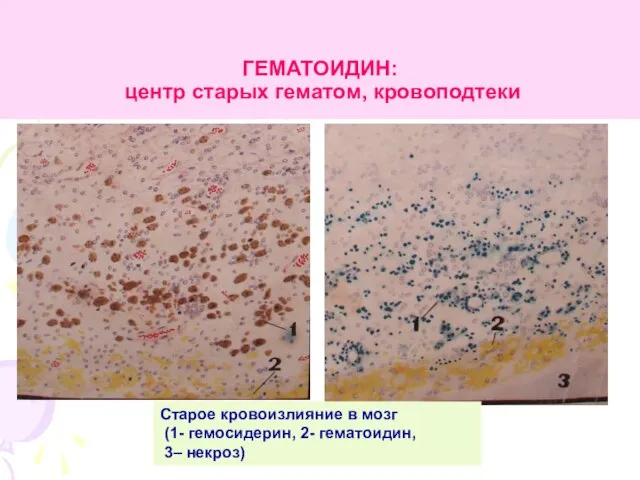 ГЕМАТОИДИН: центр старых гематом, кровоподтеки Старое кровоизлияние в мозг (1- гемосидерин, 2- гематоидин, 3– некроз)