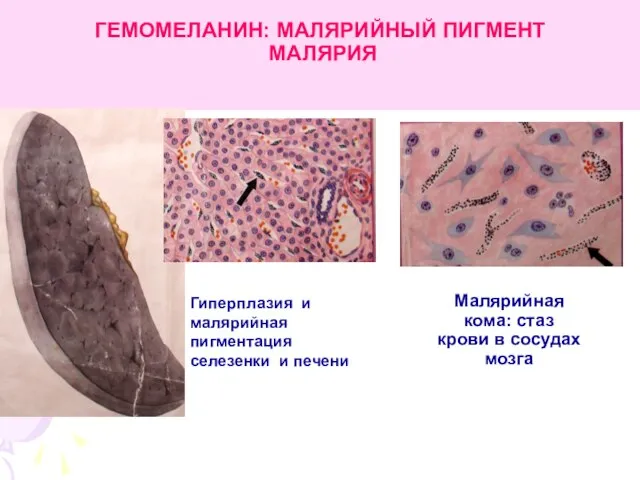 ГЕМОМЕЛАНИН: МАЛЯРИЙНЫЙ ПИГМЕНТ МАЛЯРИЯ Малярийная кома: стаз крови в сосудах мозга