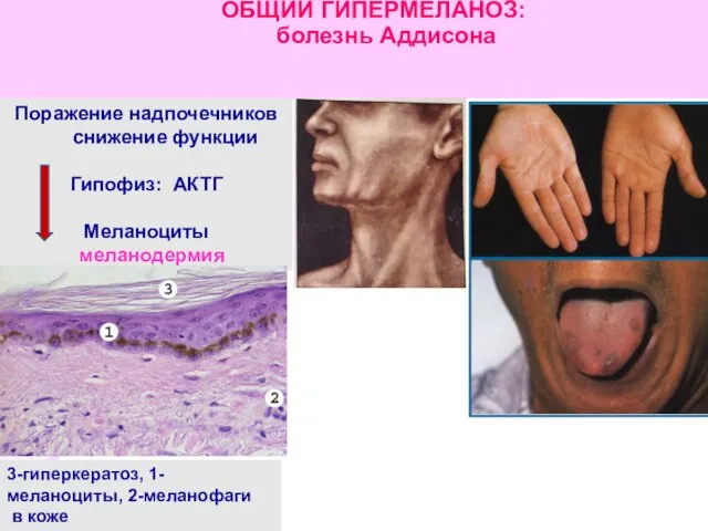 ОБЩИЙ ГИПЕРМЕЛАНОЗ: болезнь Аддисона Поражение надпочечников снижение функции Гипофиз: АКТГ Меланоциты