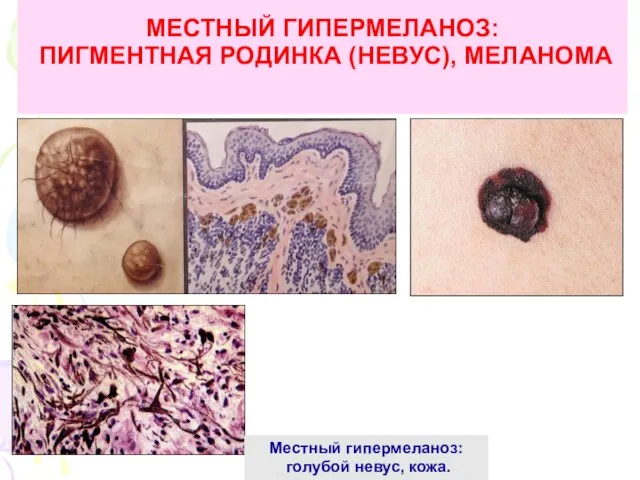 МЕСТНЫЙ ГИПЕРМЕЛАНОЗ: ПИГМЕНТНАЯ РОДИНКА (НЕВУС), МЕЛАНОМА Местный гипермеланоз: голубой невус, кожа.