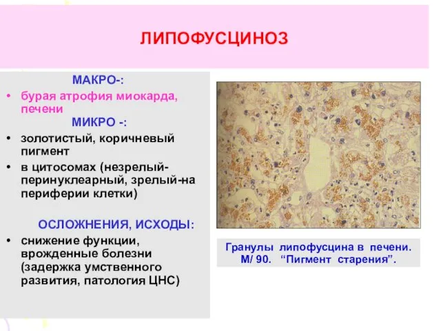 ЛИПОФУСЦИНОЗ МАКРО-: бурая атрофия миокарда, печени МИКРО -: золотистый, коричневый пигмент
