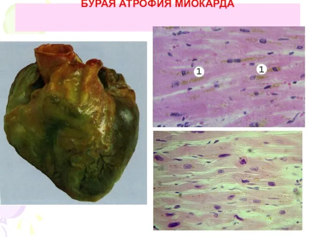 БУРАЯ АТРОФИЯ МИОКАРДА