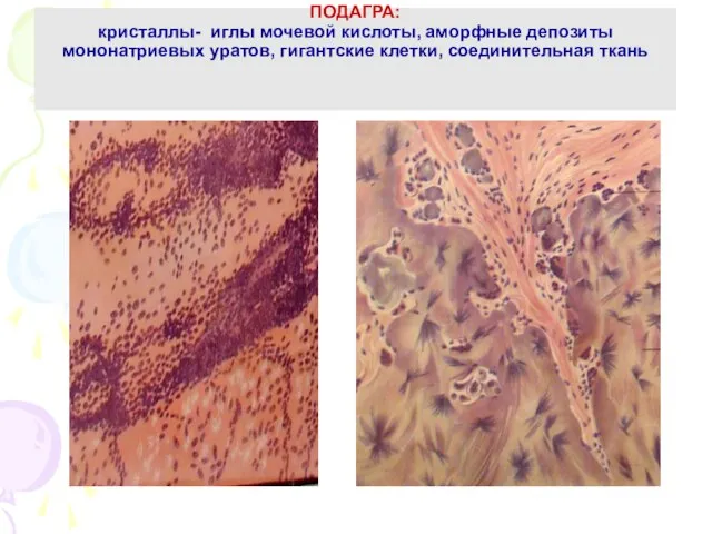 ПОДАГРА: кристаллы- иглы мочевой кислоты, аморфные депозиты мононатриевых уратов, гигантские клетки, соединительная ткань