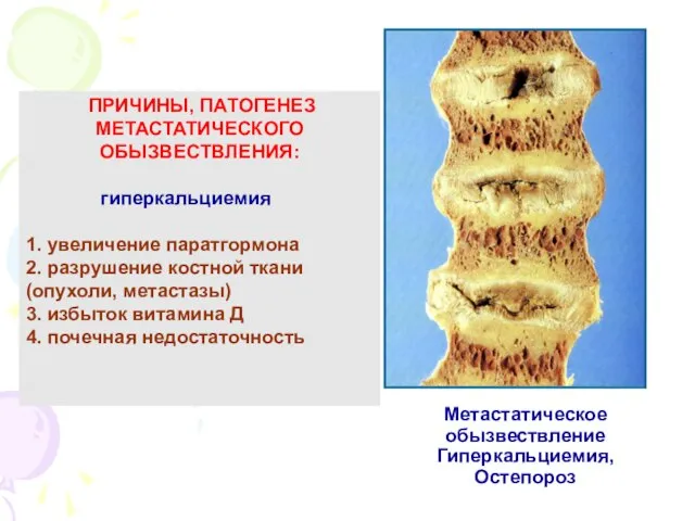 Метастатическое обызвествление Гиперкальциемия, Остепороз ПРИЧИНЫ, ПАТОГЕНЕЗ МЕТАСТАТИЧЕСКОГО ОБЫЗВЕСТВЛЕНИЯ: гиперкальциемия 1. увеличение