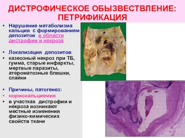 ДИСТРОФИЧЕСКОЕ ОБЫЗВЕСТВЛЕНИЕ: ПЕТРИФИКАЦИЯ Нарушение метаболизма кальция с формированием депозитов в области