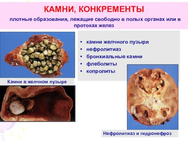 КАМНИ, КОНКРЕМЕНТЫ плотные образования, лежащие свободно в полых органах или в