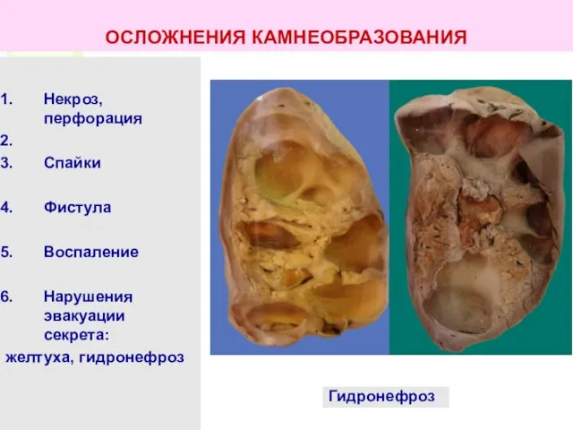 Некроз, перфорация Спайки Фистула Воспаление Нарушения эвакуации секрета: желтуха, гидронефроз Гидронефроз ОСЛОЖНЕНИЯ КАМНЕОБРАЗОВАНИЯ