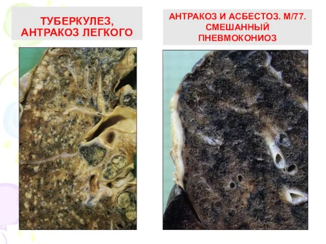 TУБЕРКУЛЕЗ, АНТРАКОЗ ЛЕГКОГО АНТРАКОЗ И АСБЕСТОЗ. М/77. СМЕШАННЫЙ ПНЕВМОКОНИОЗ