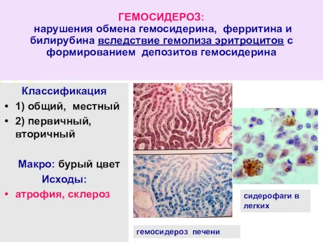 ГЕМОСИДЕРОЗ: нарушения обмена гемосидерина, ферритина и билирубина вследствие гемолиза эритроцитов с