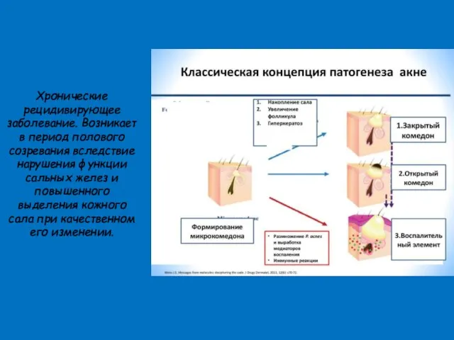 Хронические рецидивирующее заболевание. Возникает в период полового созревания вследствие нарушения функции