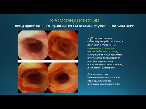 ХРОМОЭНДОСКОПИЯ метод прижизненного окрашивания ткани целью улучшения визуализации 2,5% раствор люголя