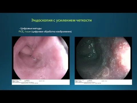 Эндоскопия с усилением четкости - Цифровые методы: FICE, I-scan (цифровая обработка изображения)