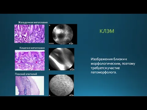 Желудочная метаплазия Кишечня метаплазия Плоский эпителий Изображения близки к морфологическим, поэтому требуется участие патоморфолога. КЛЭМ