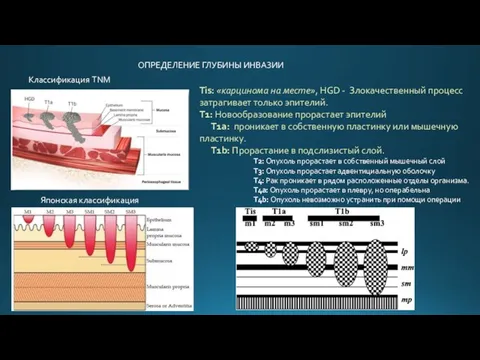 ОПРЕДЕЛЕНИЕ ГЛУБИНЫ ИНВАЗИИ Классификация TNM Tis: «карцинома на месте», HGD -