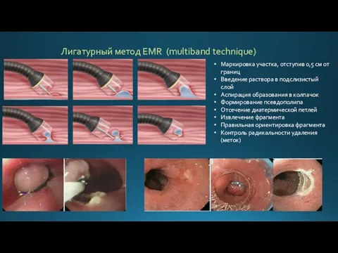 Лигатурный метод EMR (multiband technique) Маркировка участка, отступив 0,5 см от