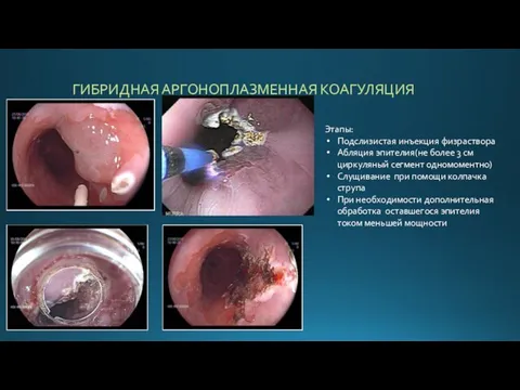 ГИБРИДНАЯ АРГОНОПЛАЗМЕННАЯ КОАГУЛЯЦИЯ Этапы: Подслизистая инъекция физраствора Абляция эпителия(не более 3