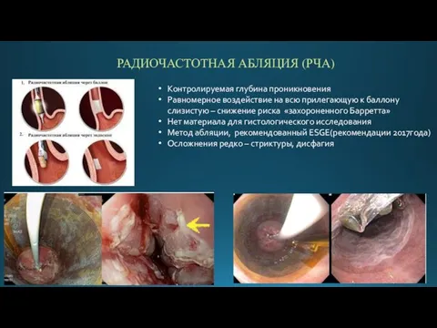 РАДИОЧАСТОТНАЯ АБЛЯЦИЯ (РЧА) Контролируемая глубина проникновения Равномерное воздействие на всю прилегающую