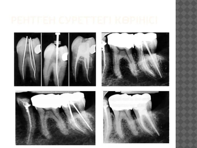 РЕНТГЕН СУРЕТТЕГІ КӨРІНІСІ